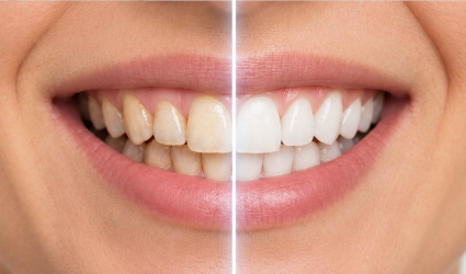 Resultado de blanqueamiento dental mostrando la diferencia entre dientes amarillentos y dientes blancos