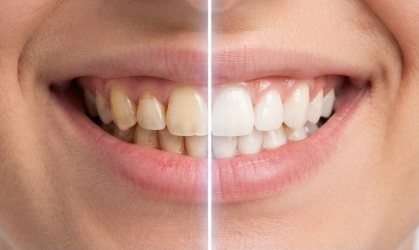 Comparativa de dientes antes y después de un tratamiento de blanqueamiento dental.